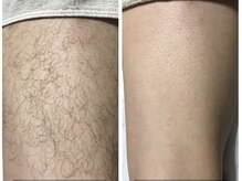 ヴィーヴ 京橋(vive)/【脱毛】太もも 3回目