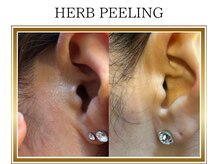 ロージー(ROSY)/ハーブピーリング/阿南/徳島