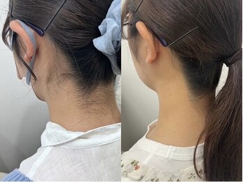 ミース 北九州店/うなじ◆ビフォーアフター