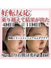 アルムダアクア 天王寺店(Aleumda AQUA)/ハーブピーリング/大阪/天王寺