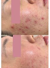 南青山コスメクリニック スキンラボ 横浜(SKIN LAB)&nbsp;ハーブ ピーリング