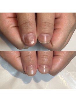 キュア(Cure.)/爪の凹凸を緩和する自爪育成