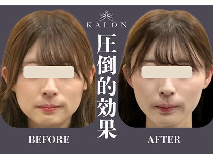 カロン(KALON)の写真
