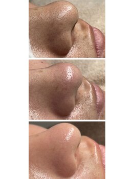 ダリア(DAHLIA)/毛穴ケア/ハイドラフェイシャル2