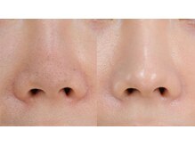 育肌美研 自由が丘サロン/人気ナンバー3★毛穴黒ずみケア