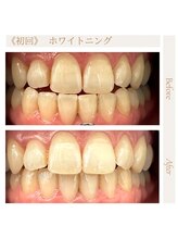 サロンドプラス(Salon de Plus)/【初回】ホワイトニング