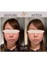 チョコバリ 錦糸町店(chocobari)/小顔×リフトアップ(美容鍼)30代