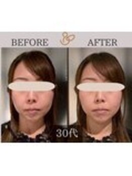 チョコバリ 錦糸町店(chocobari)/小顔×リフトアップ(美容鍼)30代