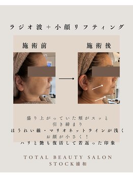 ストック 浦和(Stock)/深くなったしわを浅く!