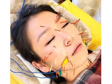 あおなみ はり きゅう整骨院/美容鍼【50本】 初めての方に◎