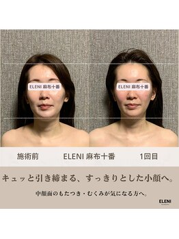 エレーニ 麻布十番(ELENI)/１回で引き締まる、上向きの印象