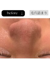 アイチューズ(ICHOOSE)/毛穴の皮脂詰まりを洗浄！