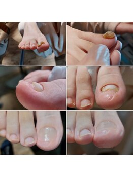 爪切り屋 足楽/肥厚爪◆人工爪へ