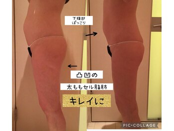 ビューティースパ/ポッコリお腹/凸凹セル脂肪改善!
