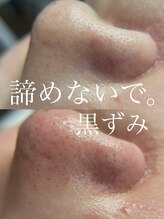 アイラッシュサロン ウェリナ 名古屋(Welina)/毛穴/鼻の毛穴/角栓/黒ずみ/鼻