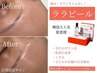  【韓国発！最新ピーリング】ララピール(顔首)ゲルパック付★未施術の方限定