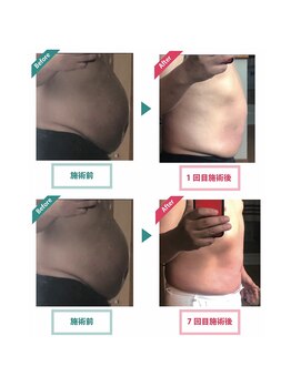 レニフォーメン(reni for men)/【男性痩身】も効果大！！