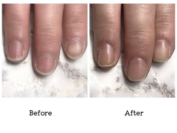 アンベリール(embellir.)/自爪・深爪育成