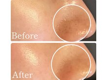 MMK/毛穴も一緒につるん/川口ハーブ