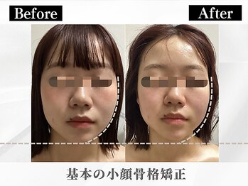 ポーベルポー(Peau Belle poe)/基本の小顔骨格矯正｜むくみ