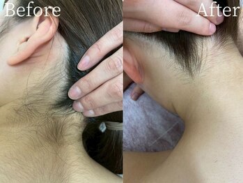 ミスティア(mistia)/脱毛【うなじ】After/3回照射