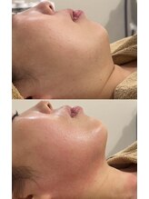 ポノティー(PONOTY)/たるみ/二重顎に徹底ケア！