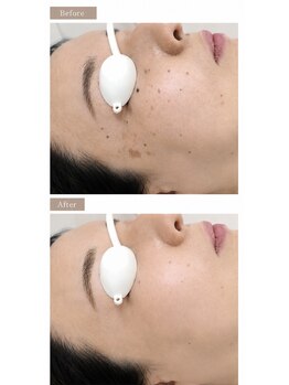 シェアキ(Chez Aki)の写真/お肌のお悩みに寄り添いアプローチするメニュー多数！当店人気の【シミケア】【肌質改善ハーブピーリング】