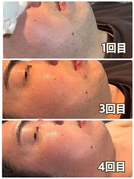 メンズ シンバ(SIMBA)/☆ ビフォーアフター ☆