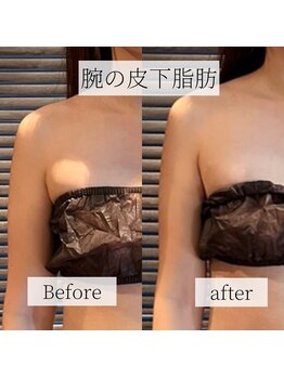 ミーツ(MEETS)/ブライダル 腕の付け根/ 1回