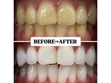 ホワイトニングサロン 豊中/Before&After美白ホワイトニング