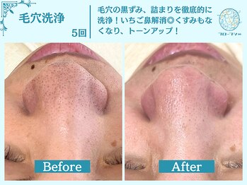 フローフシ∞/【毛穴洗浄】毛穴の黒ずみ解消