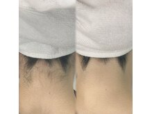 業界大人気【フォトRF脱毛】気になる毛穴にもアプローチします！