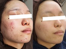 肌を土台から整えるハーブと産毛ケアWAXで未体験の透明感へ導くこだわり