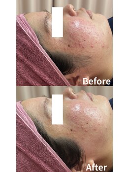 ホワイトワックス 沖縄店(WHITE WAX)/ワックス×ハイドロマスク後