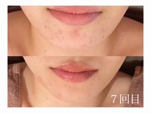 ホワイトアクア 加古川店(WHITE AQUA)/ハーブピーリングで肌荒れ改善