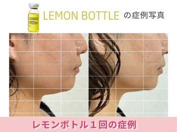 アメリイ 百合ヶ丘 新百合ヶ丘(Amerii)/【50代レモンボトル】1回の結果