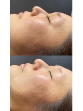 キレピア 熊本インター店(kirepia)/光フェイシャルで肌トラブル解消