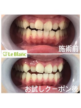 ルブラン 奈良店(Le Blanc)/年齢関係なくホワイトニング
