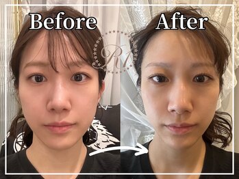 R-1ビューティーサロン 銀座/BEFORE＆AFTER