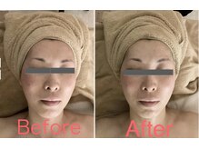アヤ(aya)/90分小顔×顔脱毛(担当Mizuho)　