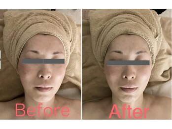 アヤ(aya)/90分小顔×顔脱毛(担当Mizuho)