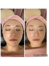 BBC 田園調布/スピダイヤコース1回の施術効果