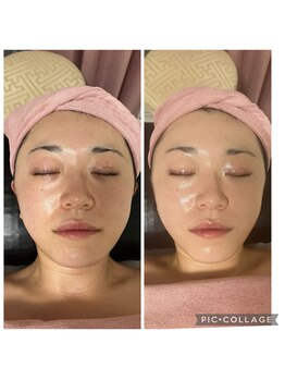 BBC 田園調布/スピダイヤコース1回の施術効果