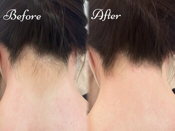 ピミル(PIMIL)/うなじ脱毛