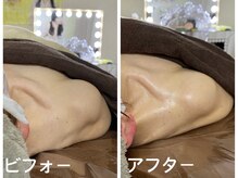 ナオフクオカ ヒーリングフォースエヌ(NaoFukuoka/healingforceN)/デコルテ、肩甲骨ケアで華奢見え
