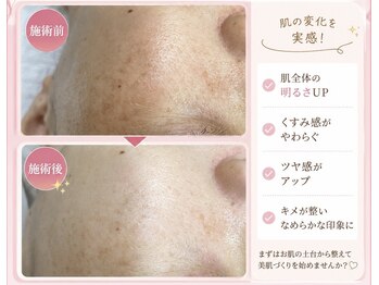ルフレの写真/毛穴黒ずみ・たるみをケアして、キュッと引き締まった小顔へ。実力派フェイシャル☆
￥7,900円～