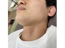 ナノハナ/鹿沼市の全身脱毛のナノハナ