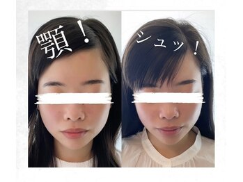 ベルミア(Bellemia)/~小顔ケア5ヶ月~