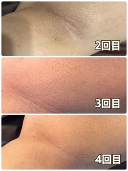 メンズ シンバ(SIMBA)/☆ ビフォーアフター ☆