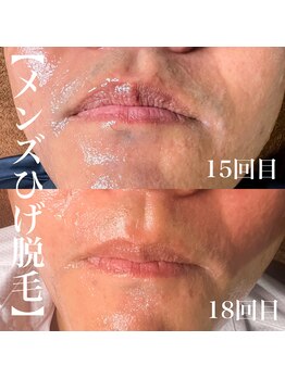 サロン リタ(Salon Rita)/メンズひげ脱毛☆